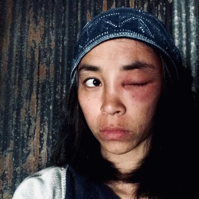 2020/2度目の蜂針治療